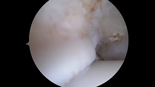 Anteromedial Soft Tissue in the Ankle after Removal of Impingement [upl. by Eniale]