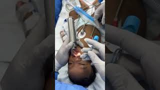 Intubating a cleft kid  Richardsons by our pediatric cardiac anesthesiologist and his team [upl. by Noirret]