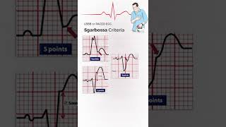 Sgarbossa Criteria to detect Acute MI in LBBB and Paced ECG shorts [upl. by Acinahs833]