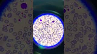 thalassemia peripheral blood smears with hypochromic microcytic red blood cells and poikilocytosis [upl. by Hilda]