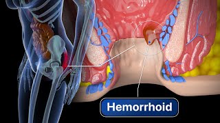 Hemorrhoid Removal  Step by step [upl. by Dru]