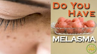 What is Melasma Melasma treatment at home  Home remedy for dark pigmentation  Home remedy melasma [upl. by Tips]