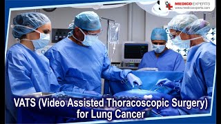 VATS Video Assisted Thoracoscopic Surgery for Lung Cancer [upl. by Eniamor]