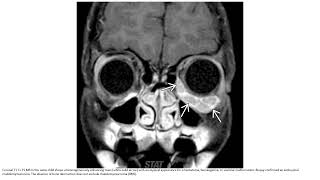 Rhabdomyosarcoma Head and Neck Imaging [upl. by Ennayhc]