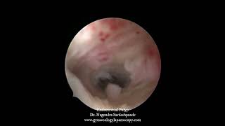 Endocervical polyp [upl. by Anbul]