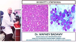 BURKITT LYMPHOMA BY DR WAFAEY BADAWY [upl. by Ardnaeed]