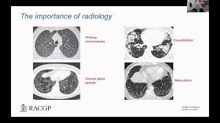 Respiratory Medicine A Comprehensive Update on Interstitial Lung Diseases [upl. by Animor447]