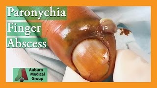 Paronychia Fingernail Abscess Infection Treatment  Auburn Medical Group [upl. by Ermey]