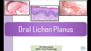 Oral Lichen Planus [upl. by Nylsor740]