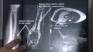 MRI NEUROGRAPHY NEUROGRAPHY SEQUENCE [upl. by Doble417]