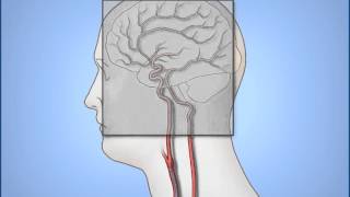 Diagnostic Cerebral Angiography [upl. by Lecroy974]