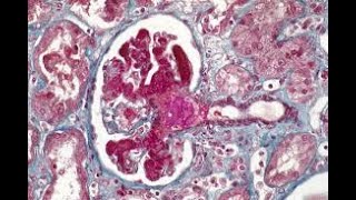 Lupus nephritis osmosis video [upl. by Itin]