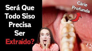 Dente do Siso – 5 COISAS INSANAS que você precisa saber sobre este dente [upl. by Trebornhoj240]