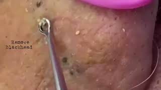 Acne Removal Remove blackhead on his lips noses removeblackhead [upl. by Uhayile]