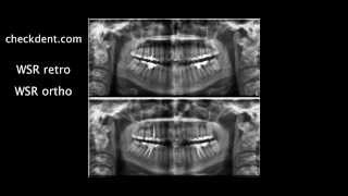 Wurzelspitzenresektion versus Endodontie [upl. by Dugald]