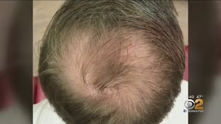 Can PRP Injections Spark Hair Growth [upl. by Harhay]