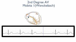 2nd Degree AV Block Mobitz Type 1 Wenckebach [upl. by Eiramlehcar530]