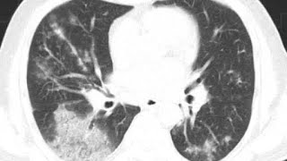 Pencillium Marneffei in Immunocompromised Diagnosis by EBUS Fungus South East Asia OI [upl. by Luthanen]