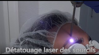 Détatouage laser des sourcils sans douleur technique simple et rapide avec une machine performante [upl. by Macguiness]