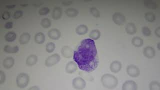 HEMEFLIX ACUTE MYELOID LEUKEMIA [upl. by Ardnasirhc622]