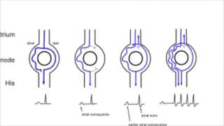 AVNRT AV nodal reentrant tachycardia [upl. by Oflodor]