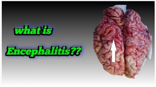 what is encephalitis [upl. by Adnihc]