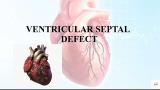 ventricular septal defectcongenital heart disorder [upl. by Alyel148]