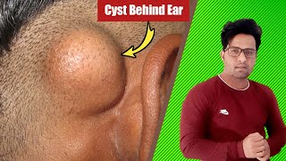 lump behind ear  कान के पीछे गांठ  kaan ke pichhe ganth ka ilaj  ear disease treatment in hindi [upl. by Okim]