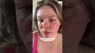 ⚡️vbeam laser for rosacea  part 1 [upl. by Auberon681]