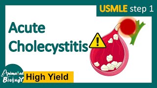 Acute cholecystitis  What is the most common treatment for cholecystitis Pathology of Acute chole [upl. by Desai91]