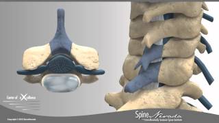 Posterior Cervical Laminectomy amp Fusion at Swift Institute Reno Sparks Carson City [upl. by Ytnom563]