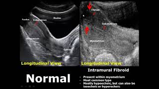 Uterus Ultrasound Normal Vs Abnormal Image Appearances Comparison  Uterine Pathologies USG [upl. by Nath]