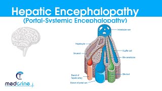 Hepatic Encephalopathy portal systemic encephalopathy causes classification featuresDX and rx [upl. by Suzanna]