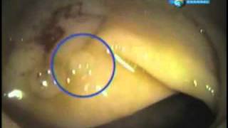 Colonoscopia Cancer al Colon Polipos Procedimiento [upl. by Cletus]