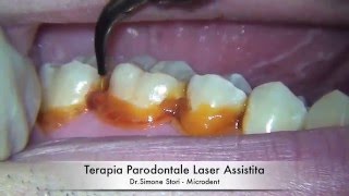 Terapia Parodontale Laser Assistita [upl. by Gnouhp]