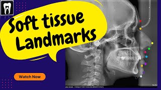 Lateral cephalogram x ray  Lateral cephalogram x ray anatomy  Soft tissu landmark [upl. by Dilaw345]