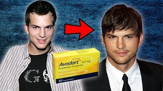 Ashton Kutcher Used Dutasteride For 10 Years To Keep His Hair [upl. by Dlaner535]