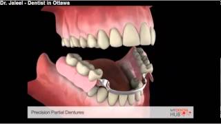 Prosthodontics  Precision Partial Denture  Ottawa Dentist [upl. by Brandie]