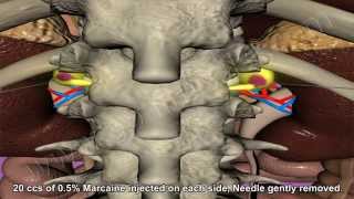 Celiac Plexus Block [upl. by Warfeld]