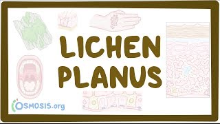 Lichen planus  causes symptoms diagnosis treatment pathology [upl. by Drucie889]