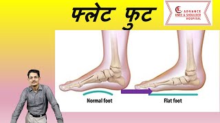 Flat Foot in Hindi फ्लैट फुट [upl. by Aihsein222]