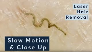 Laser Hair Removal In Slow Motion amp Close Up [upl. by Hcab]