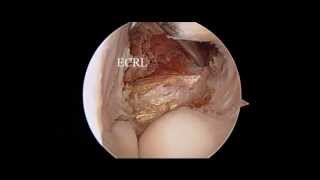 Elbow Arthroscopy  Tennis Elbow  Nicky Leung MD [upl. by Barina]