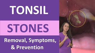 Tonsil Stones Removal Causes Symptoms Cotton Swab Treatment [upl. by Heer]