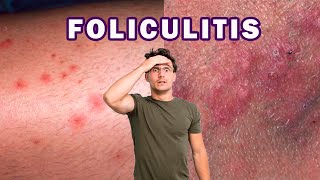 CÓMO ELIMINAR LA FOLICULITIS INFECCIOSA  BACTERIANA [upl. by Tor]