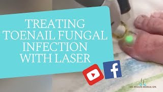 Treating Toenail Fungal Infection With Laser [upl. by Nnaeirrac443]