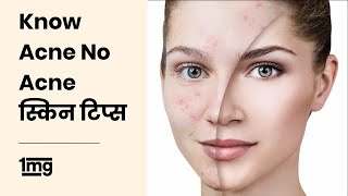 How to Remove Acne  Know Acne No Acne  Dr Priti Arya [upl. by Carrol728]