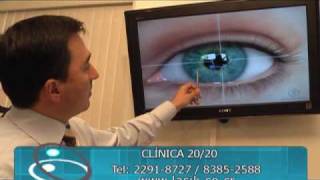 Cirugia con laser para dejar de usar anteojos [upl. by Secunda]