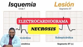 Electrocardiograma en la isquémia lesión y necrosis [upl. by Whitebook206]