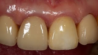 Dentium Implantium ll clinical cases [upl. by Sira]